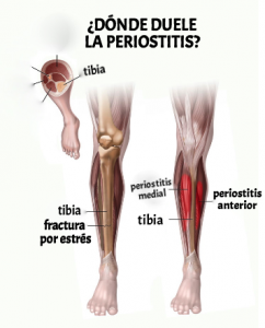 Lesion periostitis